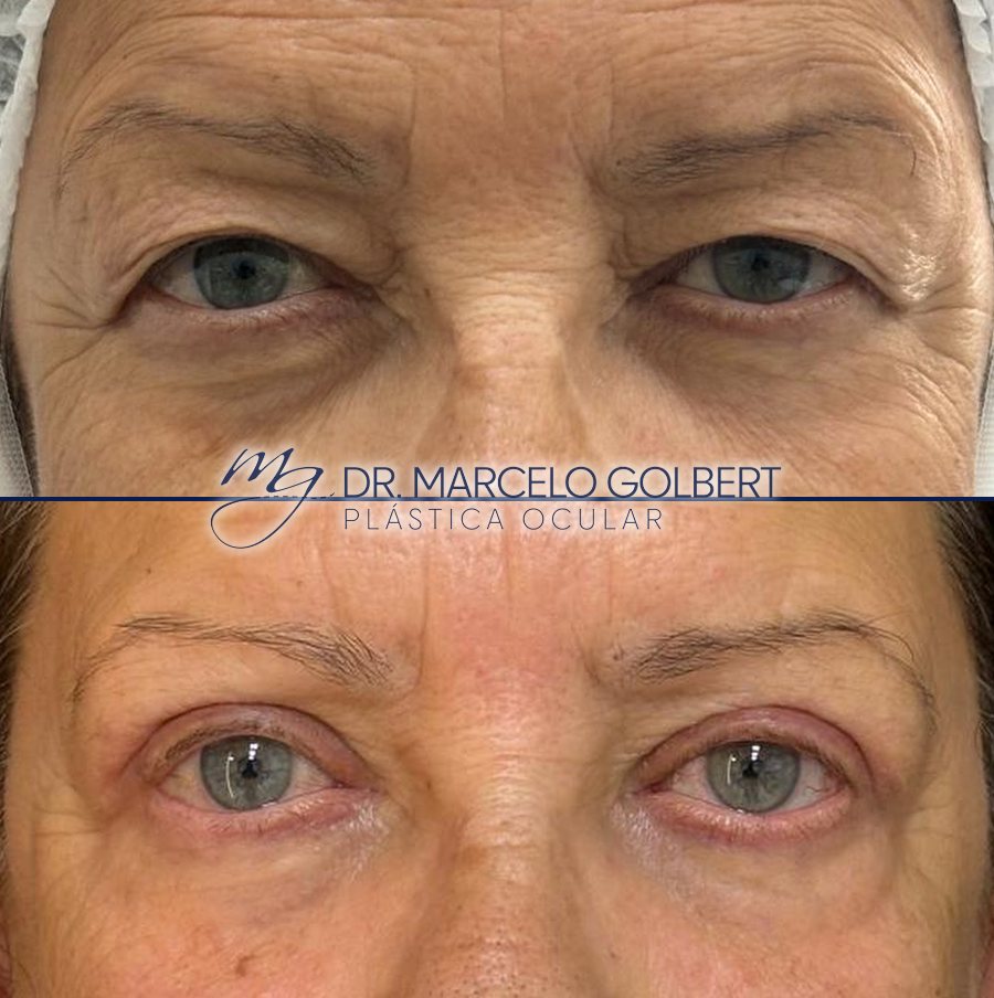 Antes e depois de blefaroplastia com o Dr. Marcelo Golbert em Porto Alegre, caso 1: acima antes da cirurgia, abaixo o resultado