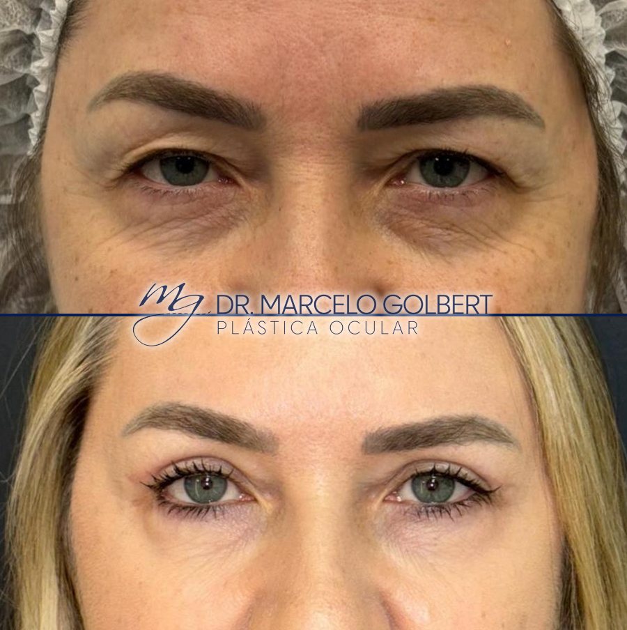 Antes e depois de blefaroplastia com o Dr. Marcelo Golbert em Porto Alegre, caso 2: acima antes da cirurgia, abaixo o resultado