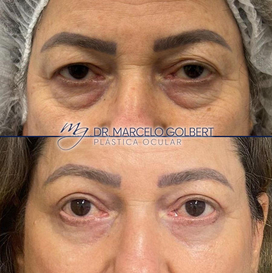 Antes e depois de blefaroplastia com o Dr. Marcelo Golbert em Porto Alegre, caso 3: acima antes da cirurgia, abaixo o resultado