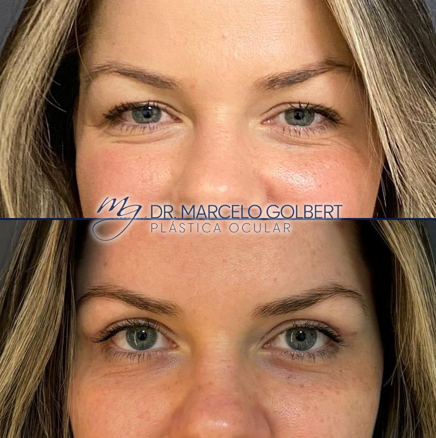 Antes e depois de blefaroplastia com o Dr. Marcelo Golbert em Porto Alegre, caso 4: acima antes da cirurgia, abaixo o resultado