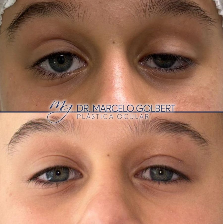 Antes e depois de blefaroplastia com o Dr. Marcelo Golbert em Porto Alegre, caso 5: acima antes da cirurgia, abaixo o resultado
