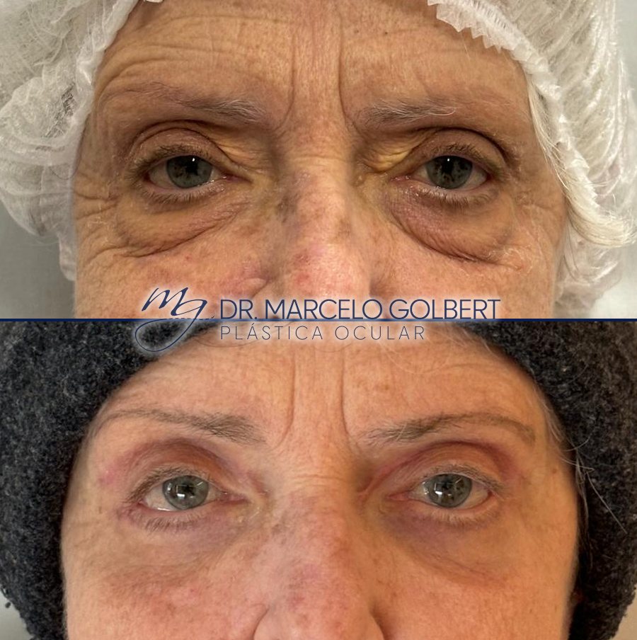 Antes e depois de blefaroplastia com o Dr. Marcelo Golbert em Porto Alegre, caso 6: acima antes da cirurgia, abaixo o resultado