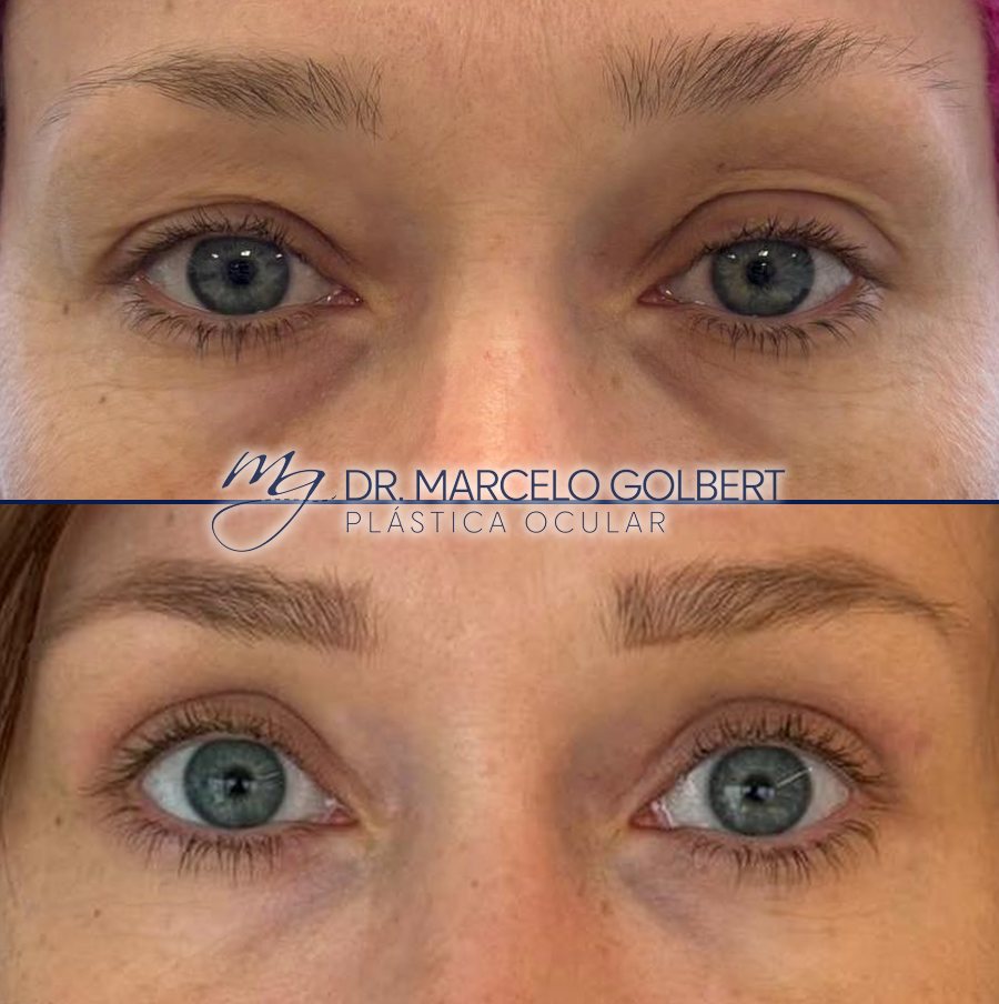 Antes e depois de blefaroplastia com o Dr. Marcelo Golbert em Porto Alegre, caso 7: acima antes da cirurgia, abaixo o resultado
