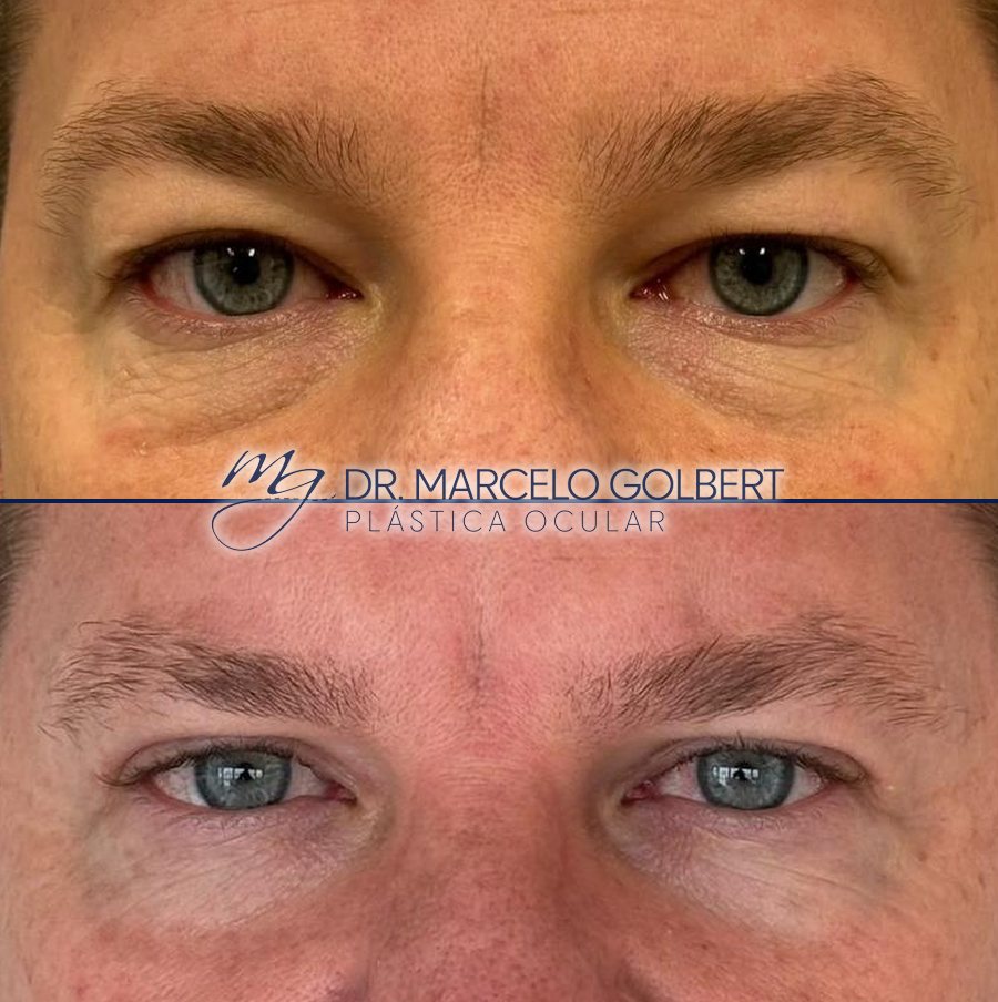 Antes e depois de blefaroplastia com o Dr. Marcelo Golbert em Porto Alegre, caso 8: acima antes da cirurgia, abaixo o resultado