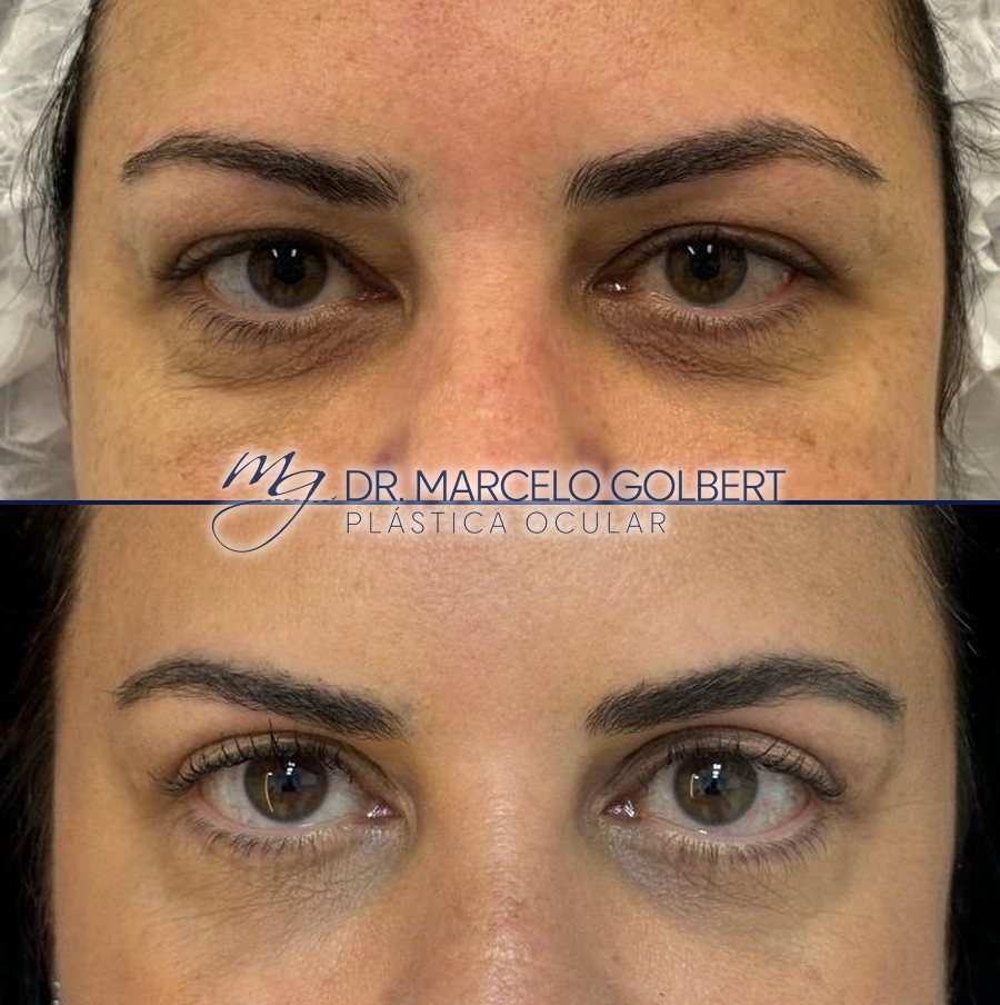 Antes e depois de blefaroplastia com o Dr. Marcelo Golbert em Porto Alegre, caso 9: acima antes da cirurgia, abaixo o resultado