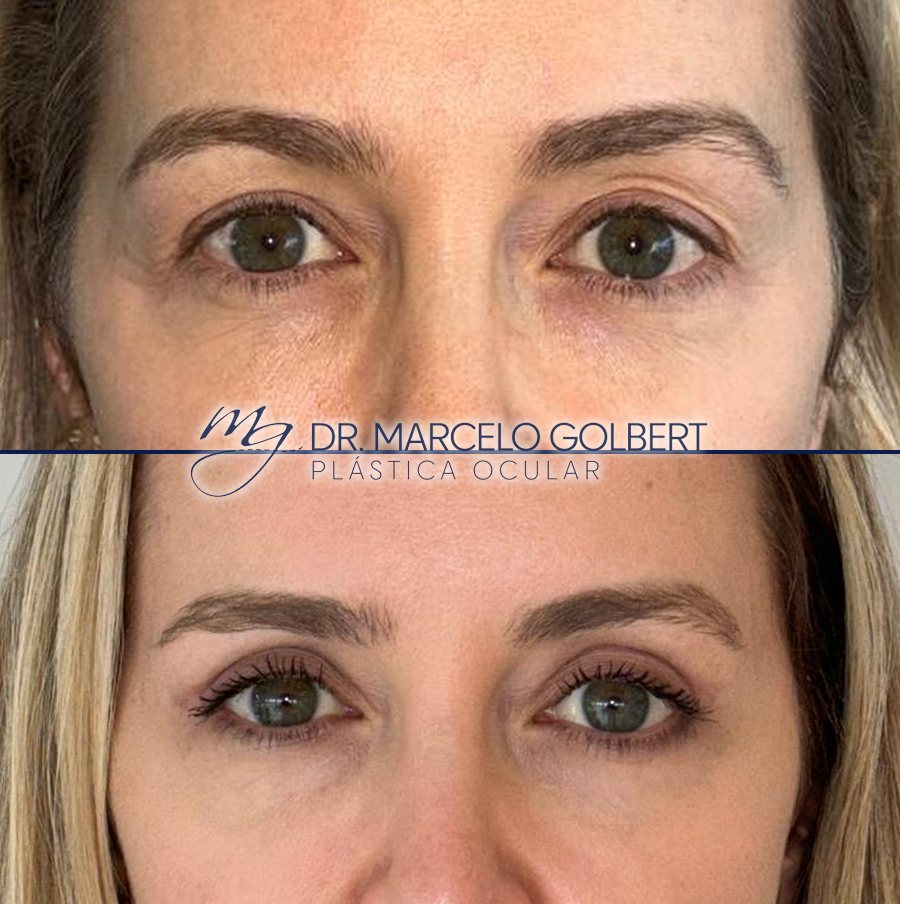 Antes e depois de blefaroplastia com o Dr. Marcelo Golbert em Porto Alegre, caso 10: acima antes da cirurgia, abaixo o resultado