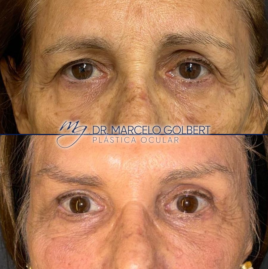 Antes e depois de blefaroplastia com o Dr. Marcelo Golbert em Porto Alegre, caso 11: acima antes da cirurgia, abaixo o resultado